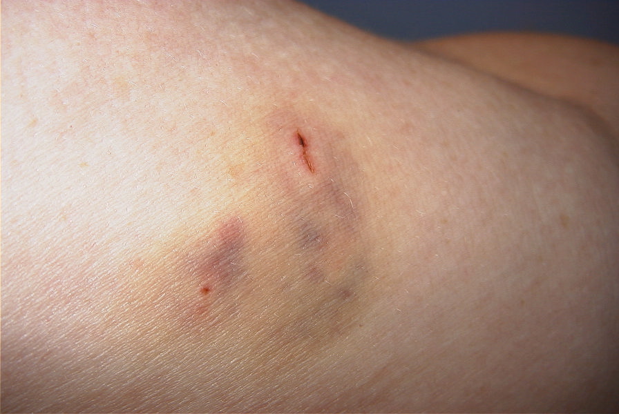 dog bite on arm